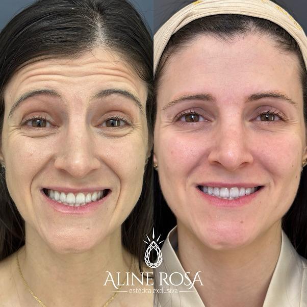 Bioestimulador Facial